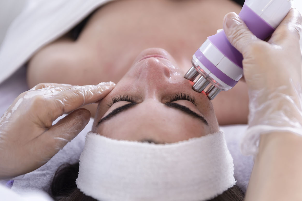 Radiofrecuencia facial en Madrid